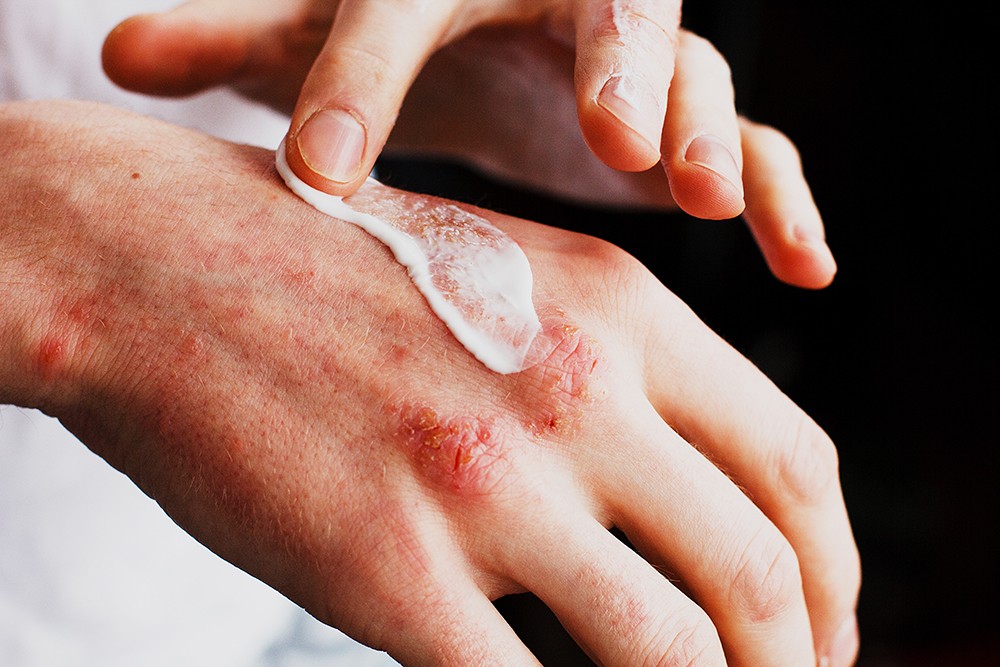 Get Rid of Eczema Forever