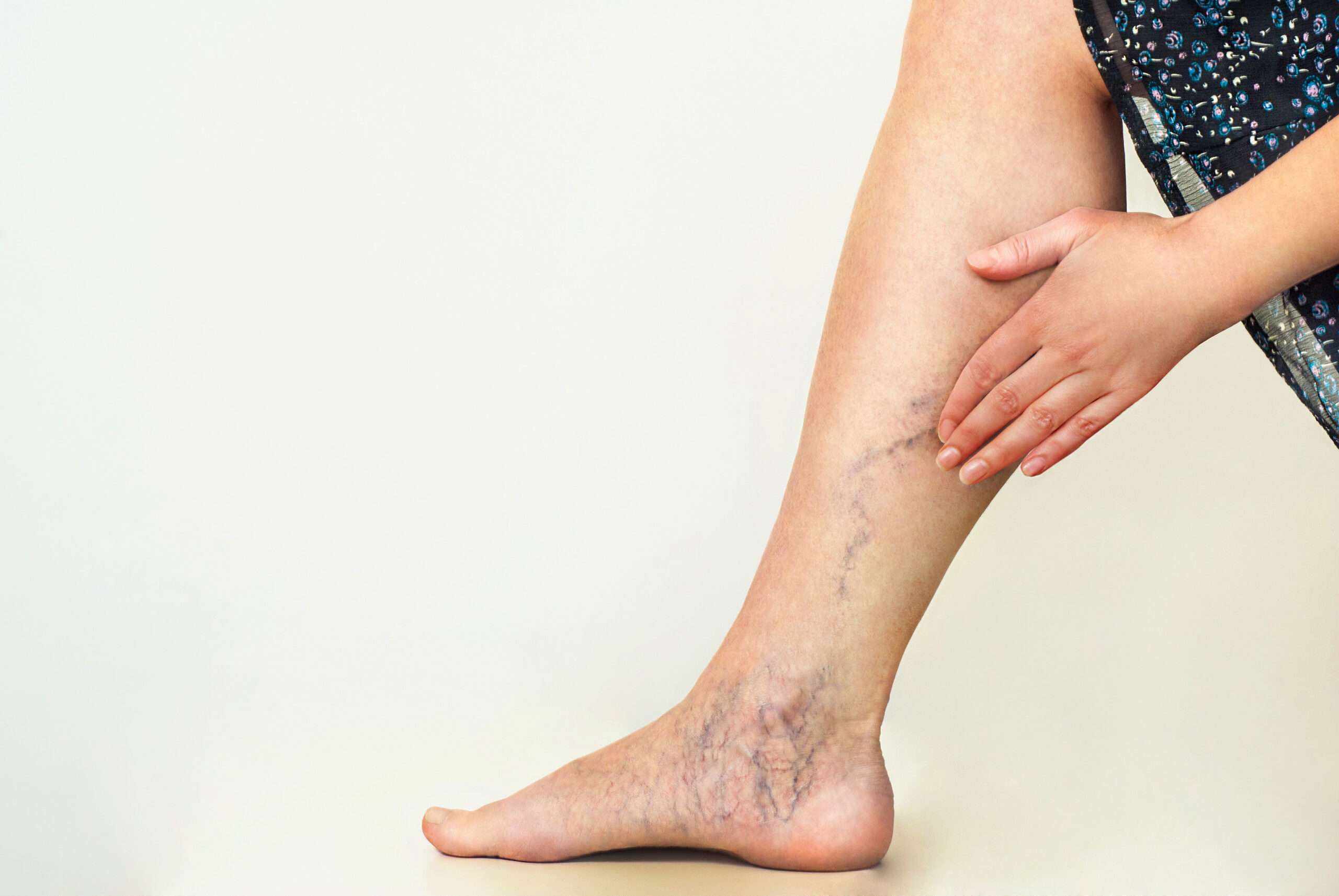 Herbs for Legs without Varicose Veins